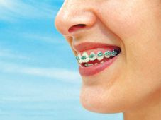 ಸುಂದರ ದಂತ ಜೋಡಣೆ ಹಿಂದಿನ ಕೈ... ಆರ್ತೋಡೊಂಟಿಕ್ಸ್ ಅಧ್ಯಯನದ ಬಗ್ಗೆ ಒಂದಿಷ್ಟು!