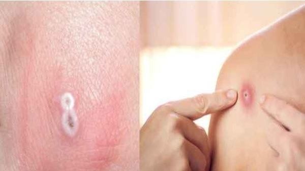 How Monkeypox Is Spread?