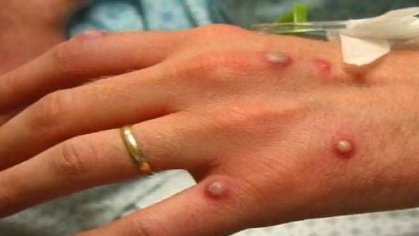 What are the symptoms of Monkeypox?